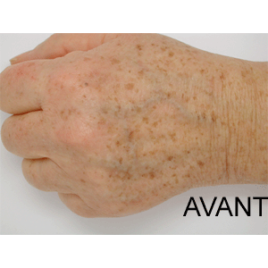 Brazowe+Plamy+Na+Skorze Brazowe Plamy Na Skorze http://naturale.pl/rbs-brazowe-plamy-starcze-p ...